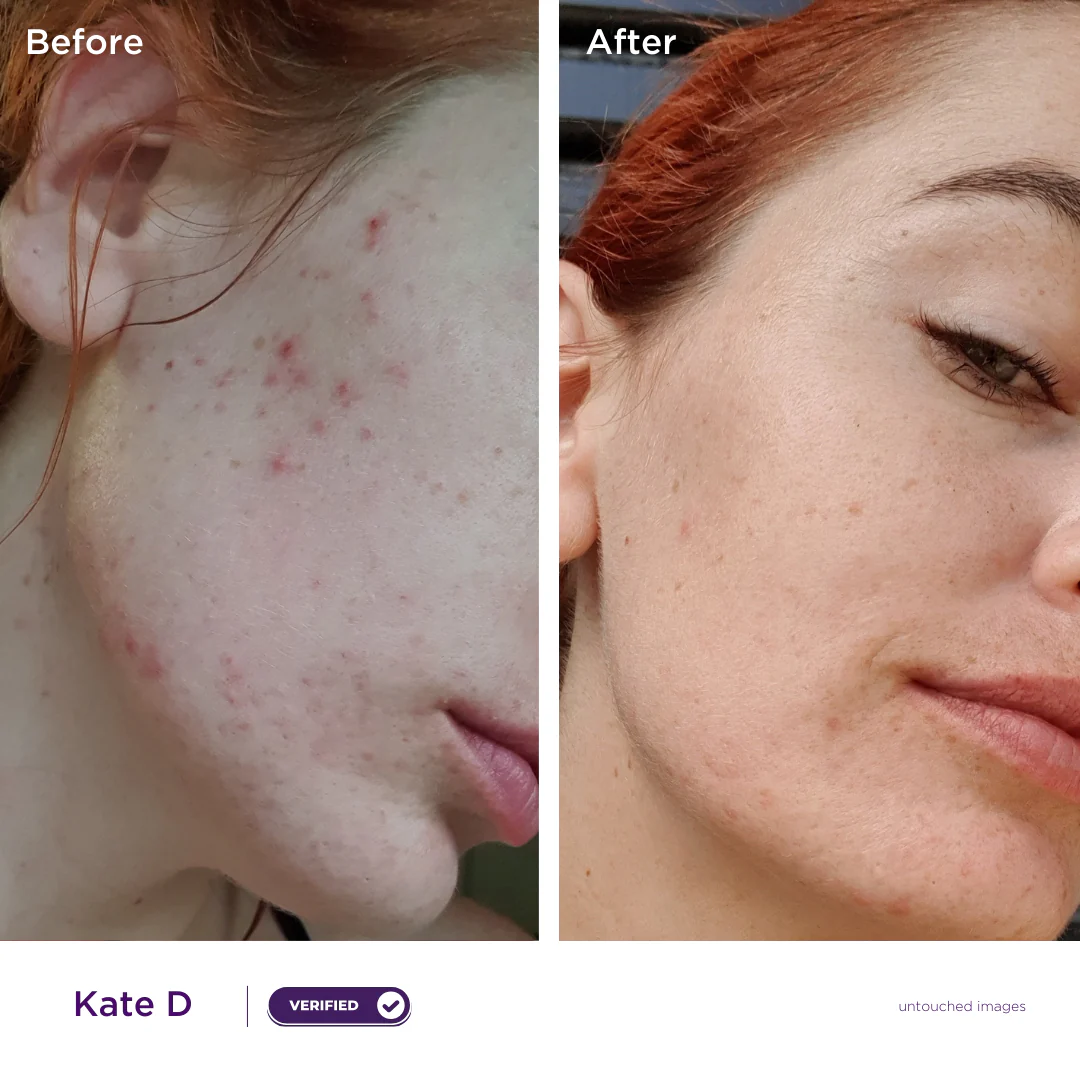 Starter Acne Kit - Image 4